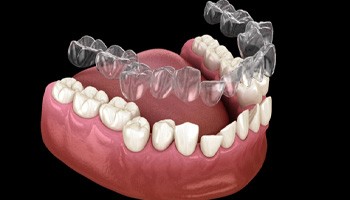 Illustration of clear aligner being placed on crooked teeth