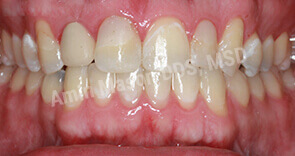 invisalign case 10 after