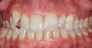 invisalign case 2 before