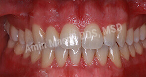 invisalign case 3 after