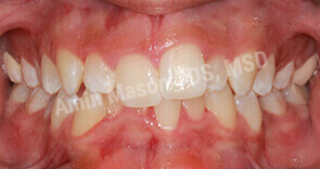 invisalign case 4 before