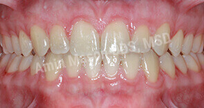 invisalign case 5 after