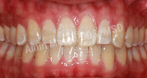 invisalign case 6 after
