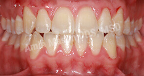 invisalign case 7 after
