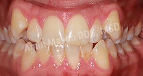 invisalign case 7 before