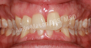 invisalign case 8 before