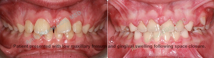 Smile before removal of excess gum tissue