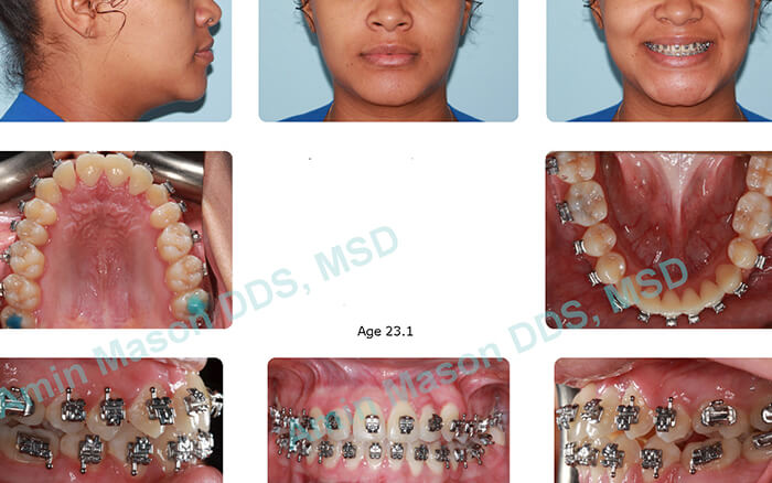 Woman during self-litigating braces