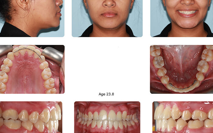 Woman's flawless smile after self-litigating braces