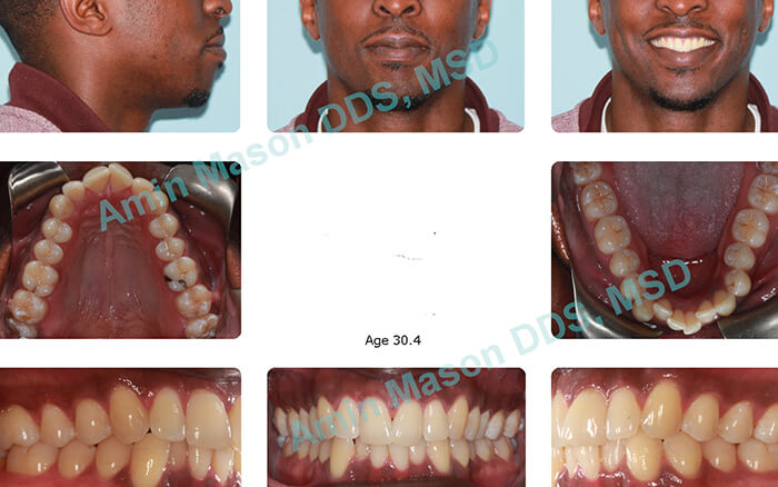 Orthodontics – Braces & Lingual Braces (invisible) - Advanced