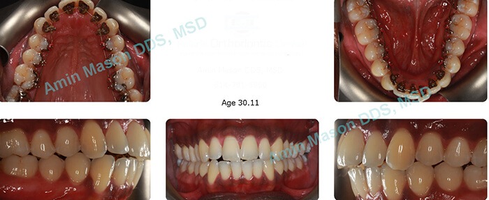 Images of man's smile during treatment with Incognito braces
