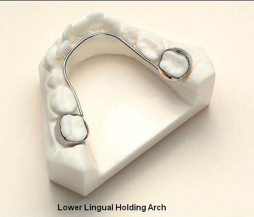 Model of teeth with lingual holding arch