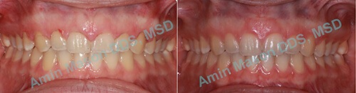 Before and after photos of a smile with gingival recontouring