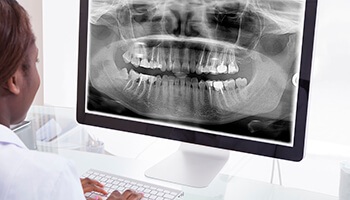 Panoramic dental x-rays on computer monitor