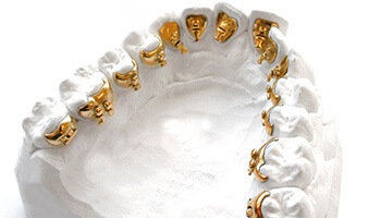 Gold-colored Incognito braces on backs of teeth