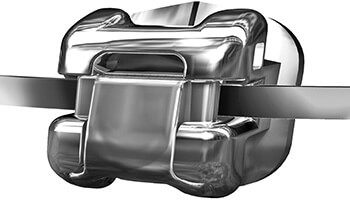 Closeup of a self-ligating bracket