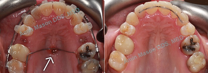 Before and after TADs used to close space from lost teeth