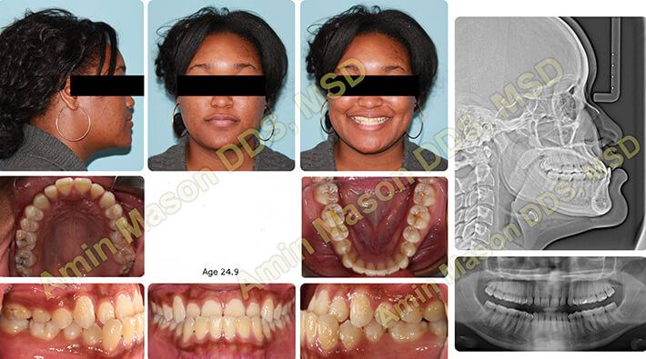 Woman with severe underbite