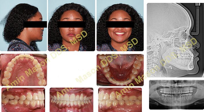 Woman following skeletal treatment for underbite