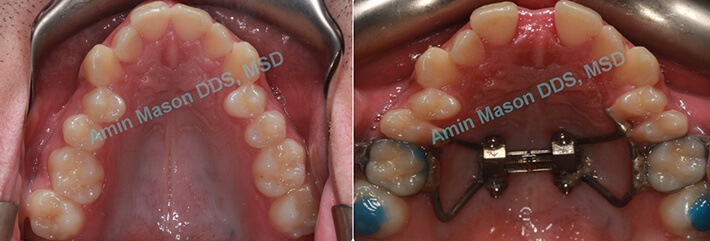 Evenly spaced smile following TADs treatment