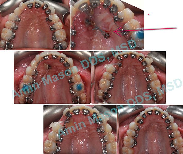 Series of photos showing TADs treatment for an impacted tooth