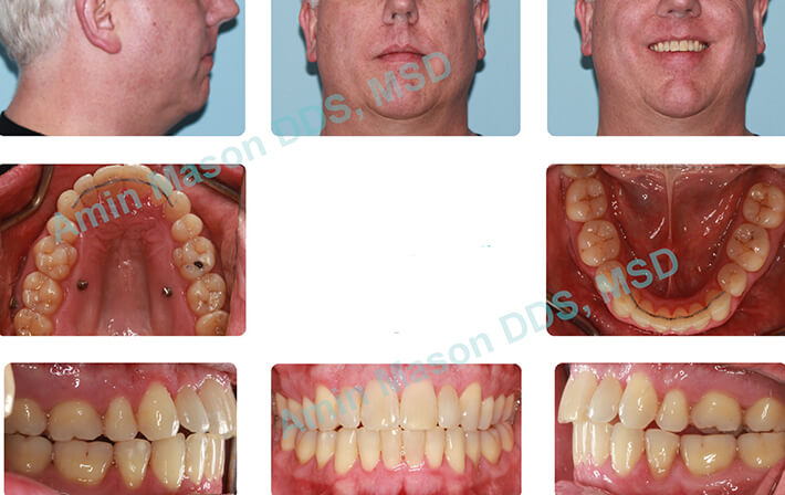 Older man's closed bite after TADs treatment