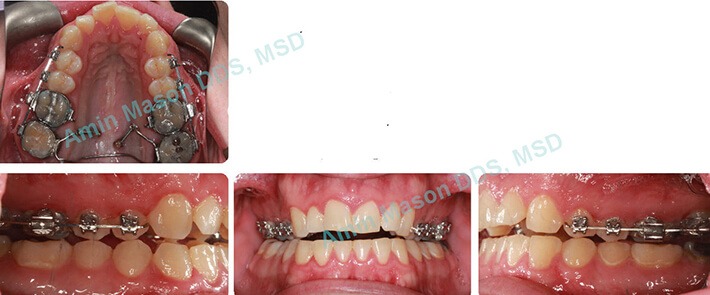 Adult male with open bite during TADs treatment