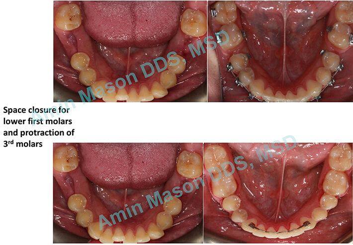 Before and after images of teeth with TADs treatment