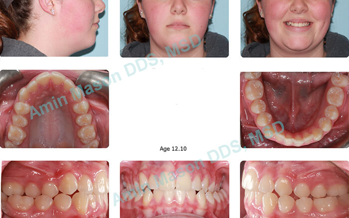 Young woman with crossbite