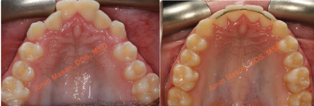 before and after restoration