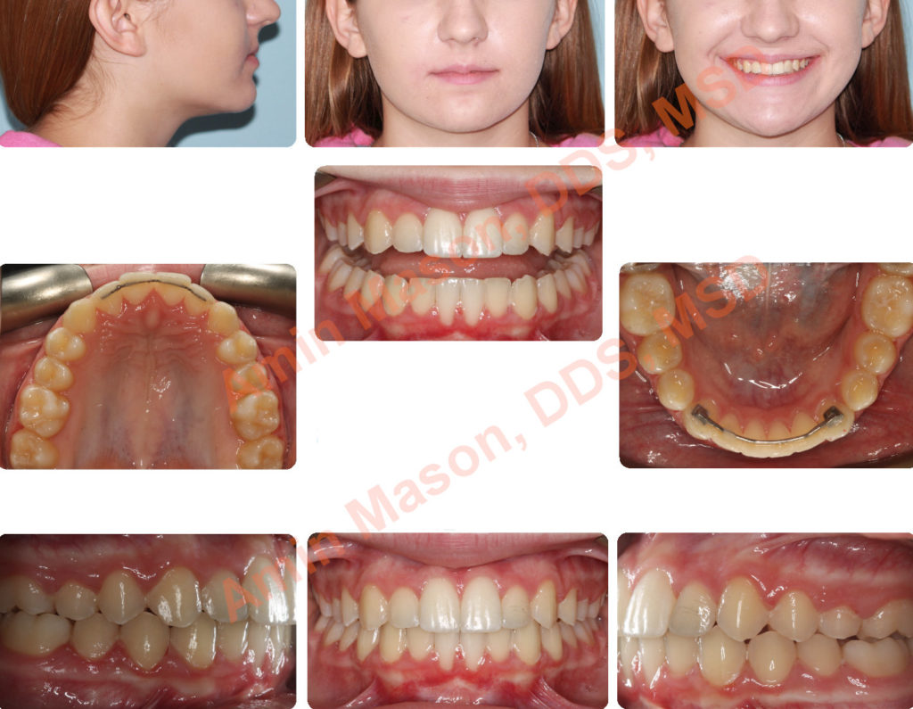 Teenager after restorations