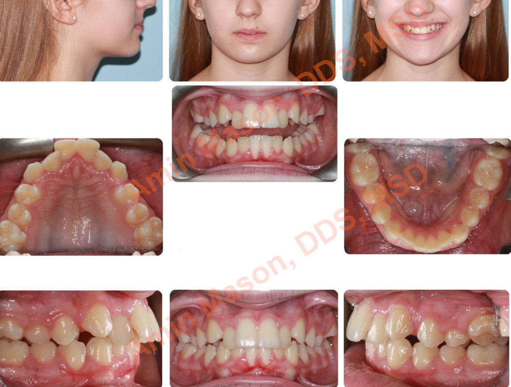 Teenager before and after restoration