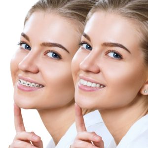 Young female patient smiling before and after braces removal