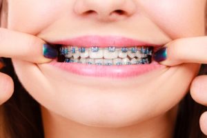 Girl pulling back lips to show traditional braces